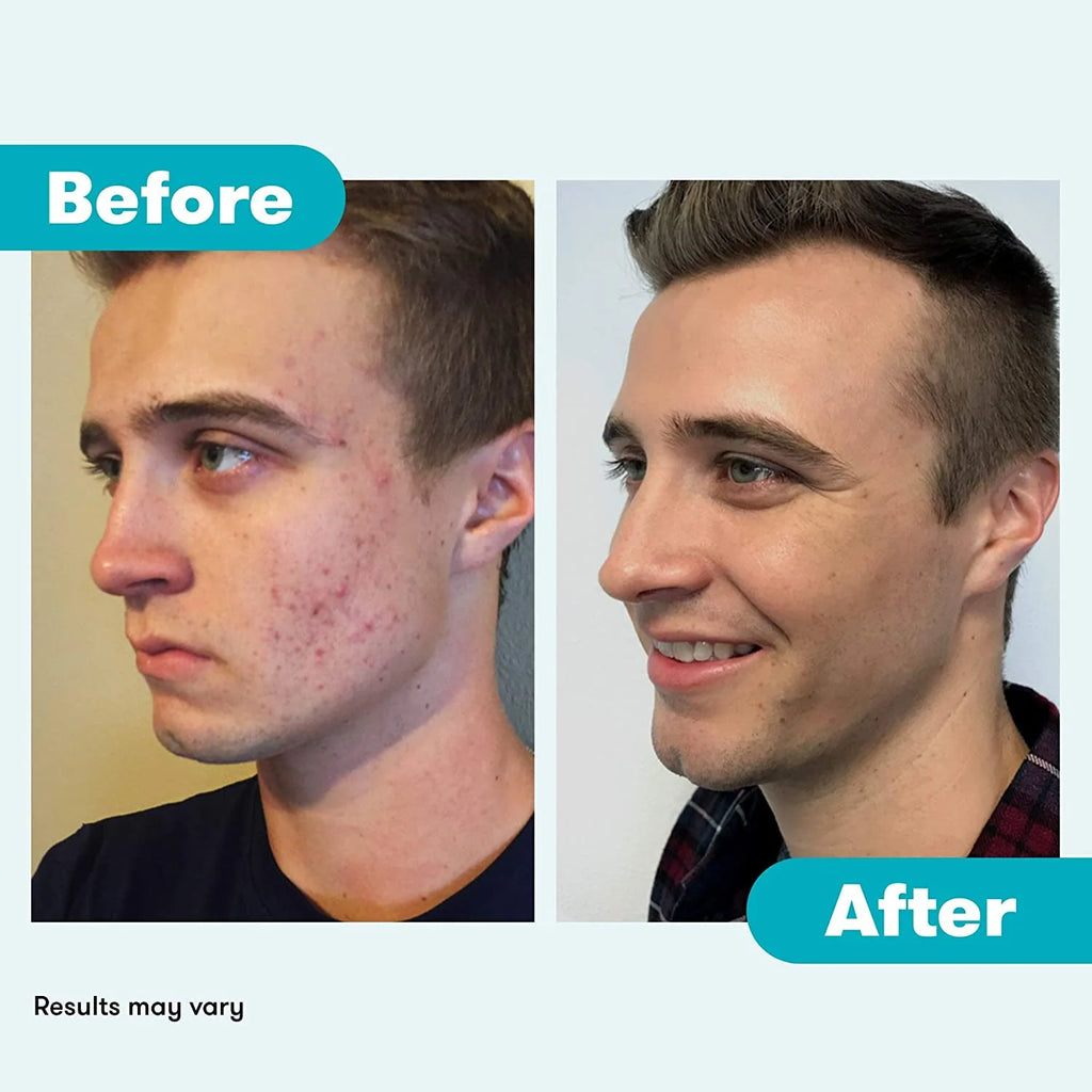 Acne System with Purifying Mask J152722
